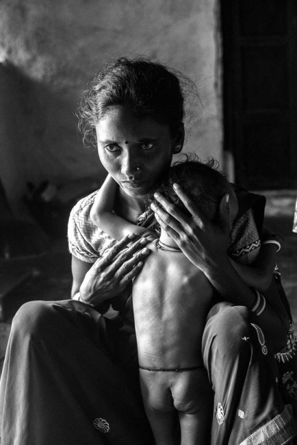 Malnutrition stalks India’s children 0